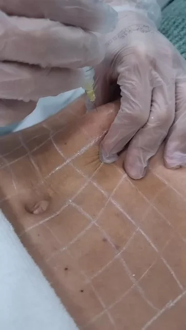 Endermoterapia