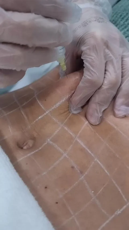 Endermoterapia