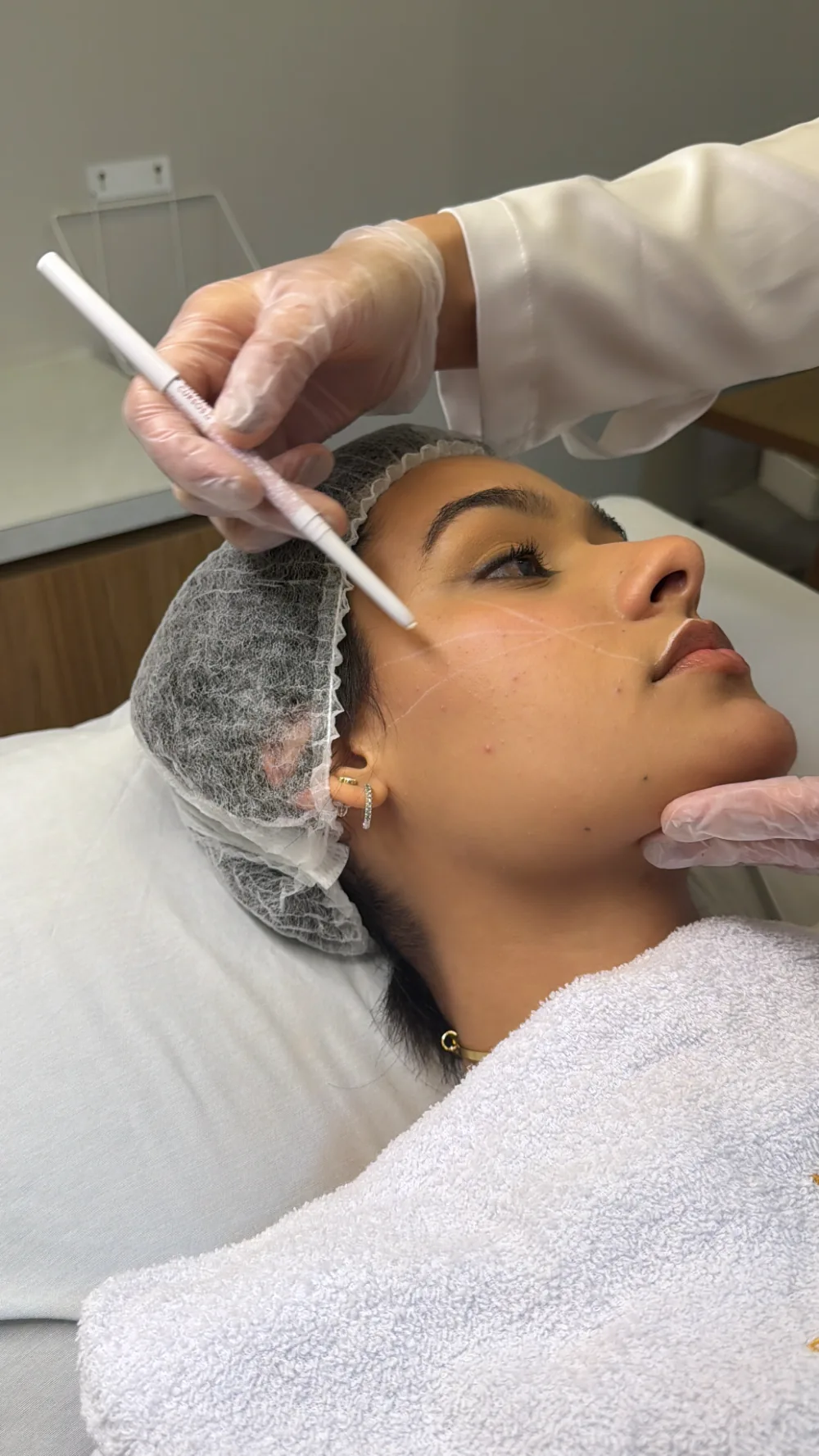 Marcação facial antes do preenchimento na Bella Linea