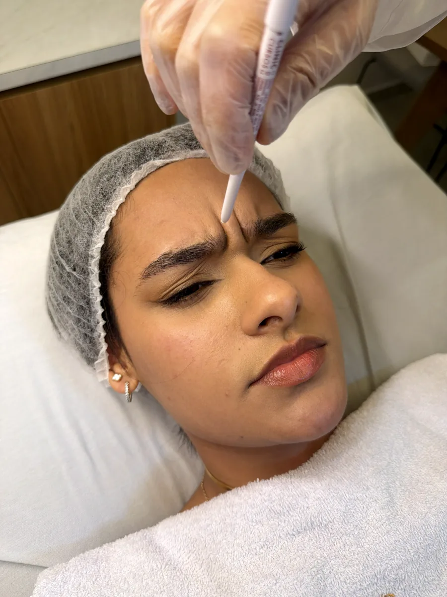 Marcação de ponto na glabela durante avaliação da musculatura