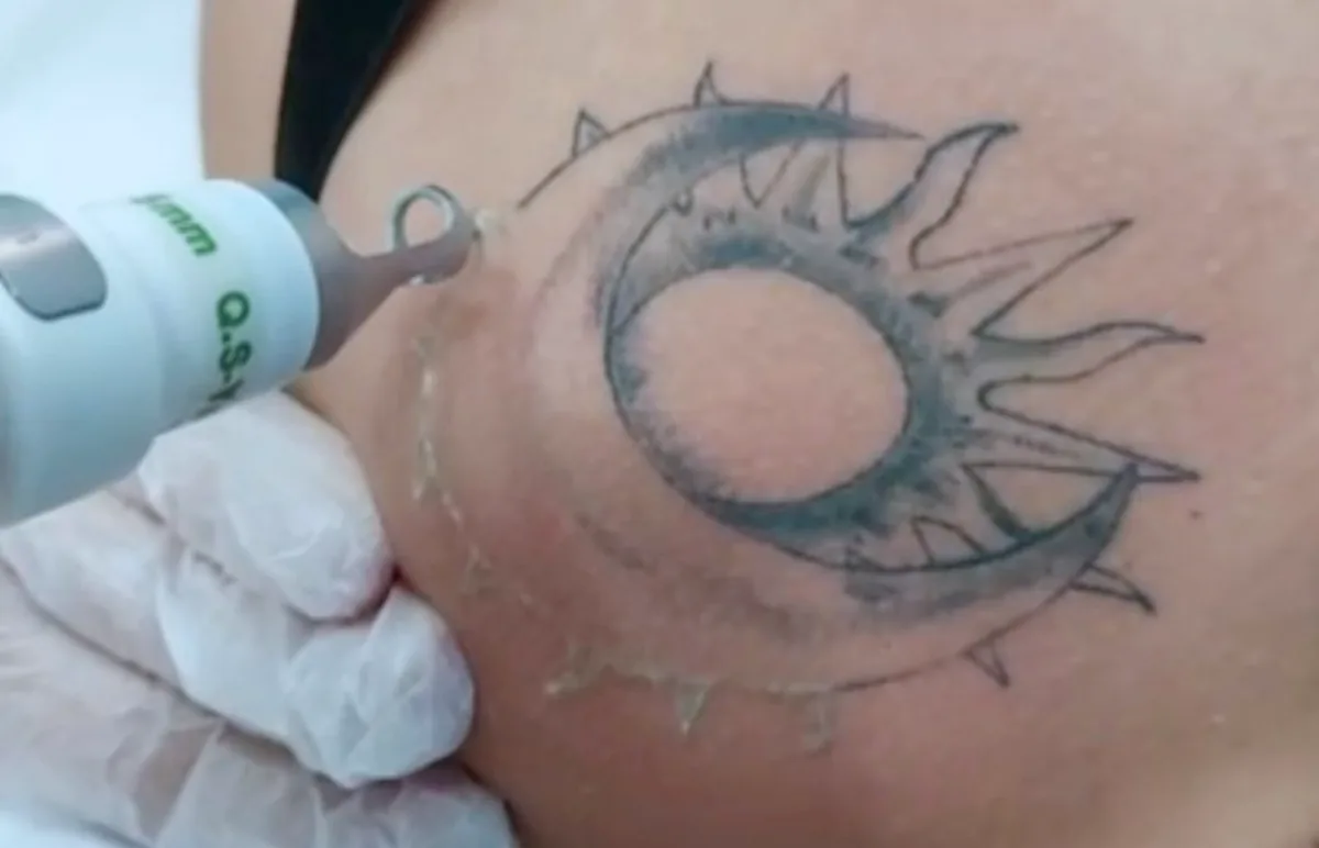 Sessão de depilação a laser com Light Sheer na Bella Linea